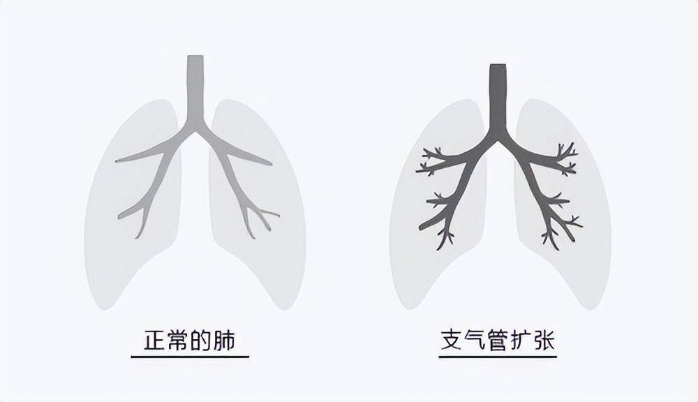 出现10个症状，可能是支气管扩张！这8类人要注意！做好日常预防