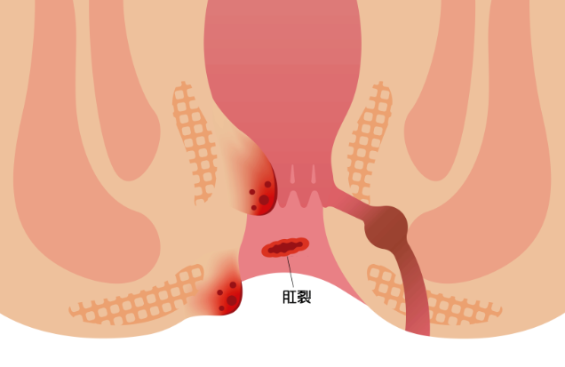 丹东肛肠 哨兵痔和普通痔疮有什么区别？原来都是肛裂惹的祸