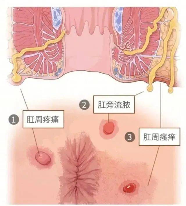 从皮肤上的开口上渗出，甚至严重的会有漏粪的现象。02肛瘘有哪些症状？