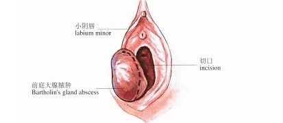 。若发现红色脓肿，这通常是感染的信号，并可能导致剧烈的外阴部疼痛。