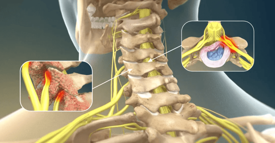 肩颈疼痛如何自我神经牵引？