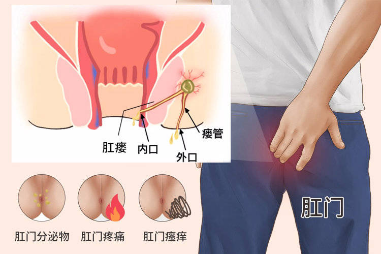 肛周脓肿、肛瘘等，而肛瘘一旦形成是无法自愈的，还需要接受手术治疗。3、肛周瘙痒肛门处如果长期不清洗，