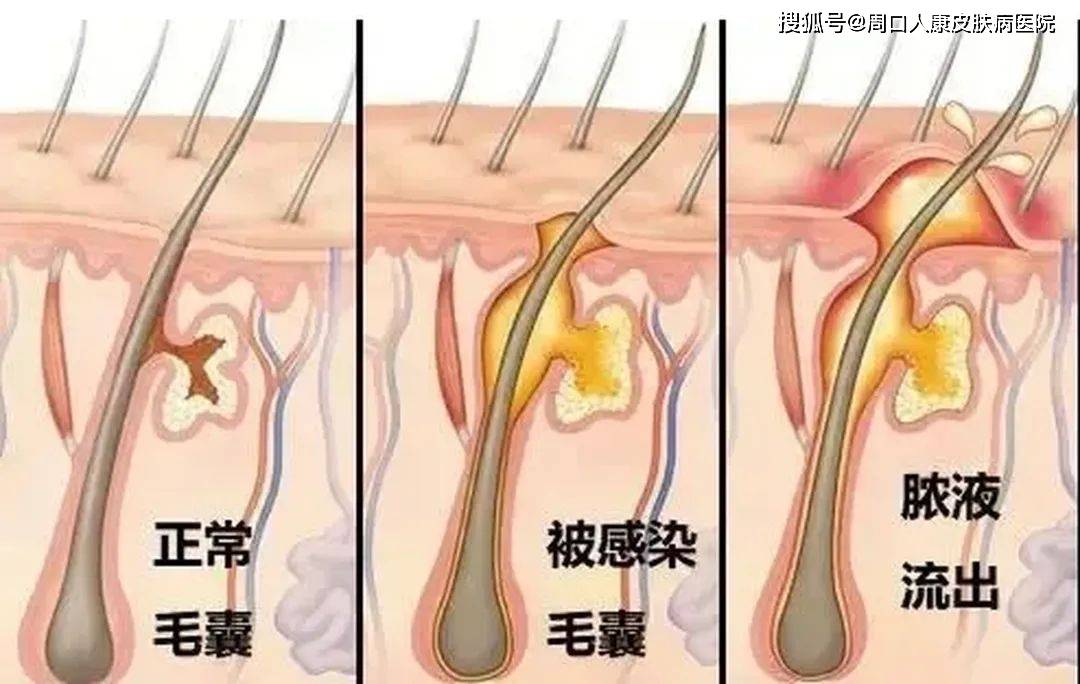 【周口人康皮肤病医院】毛囊炎症状表现有哪些？需要怎么预防？