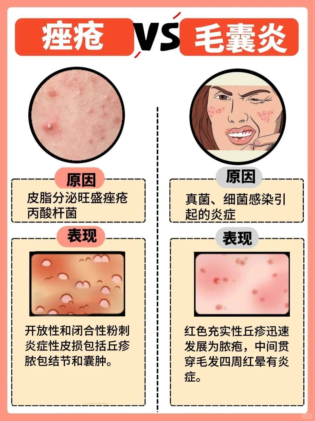 痤疮和毛囊炎不一样千万别弄混了