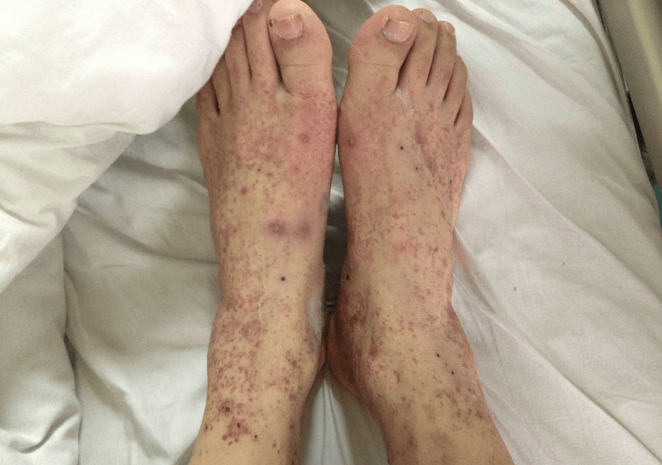 血液科杨淑莲医生：特发性血小板减少性紫癜的预防措施