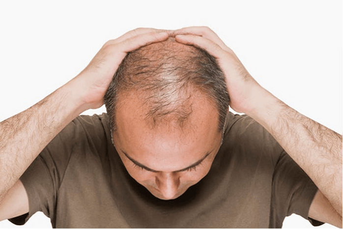黑米纹发(SFP)：纹发效果能保持几年？