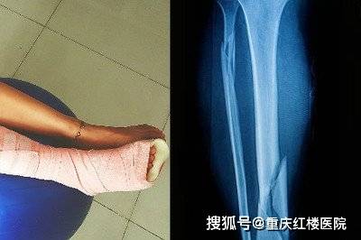 如果骨折需要手术治疗,手术后多久能康复