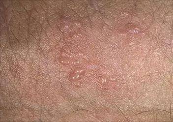 感染5亿人的生殖器疱疹,最喜欢这五种人!别中招了,赶紧预防!