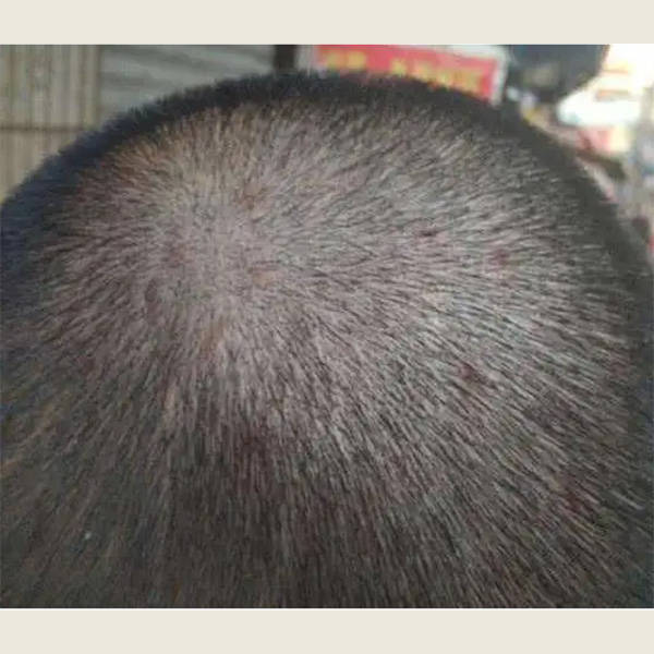 用洗发水头皮屑多是什么原因？？【长效去屑，头皮护理的窍门】