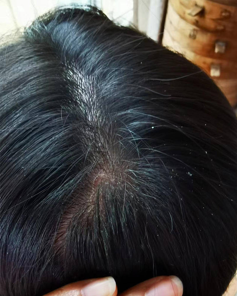 什么洗发水洗完头不痒？头皮止痒最快的洗发水推荐