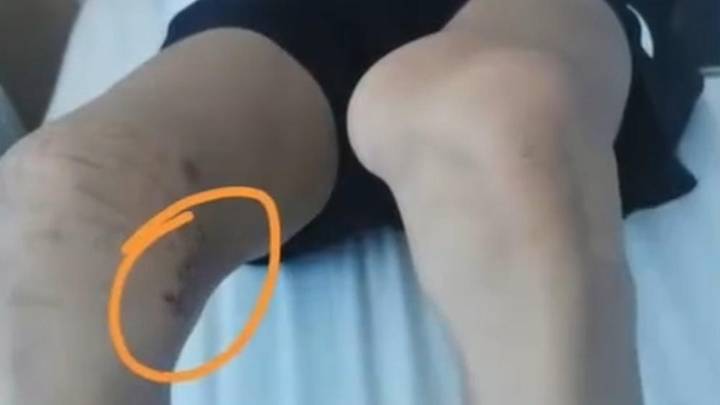 17岁体育生左膝长骨瘤遭错切右膝,医院有责任吗?
