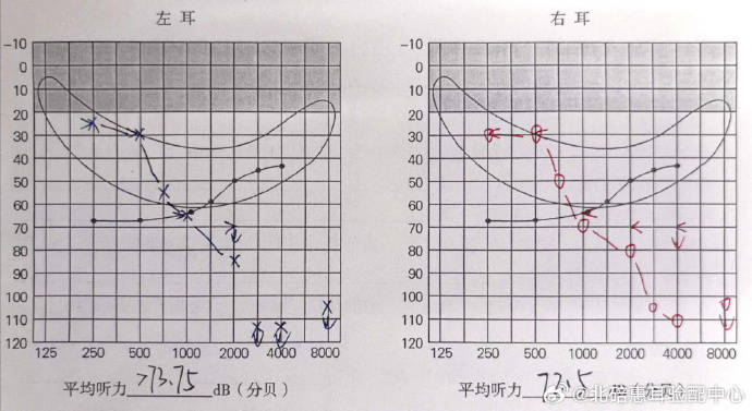 垫江惠耳分享：陡降型感音神经性耳聋的干预，赛阁10RIC(图2)