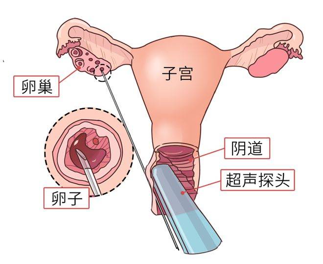 解析广州供卵技术与性别选择的科学与伦理