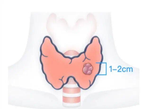 儿童得了甲亢，治疗和成人有区别吗？