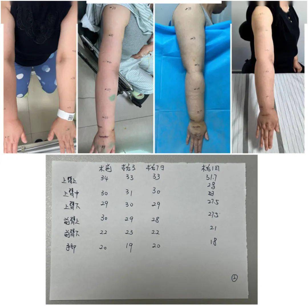 【医文医话】显微修复重建外科：淋巴回流障碍致肢体肿胀的治疗答疑