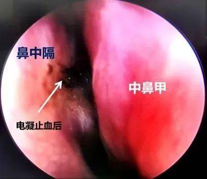 【便民诊疗介绍】耳鼻咽喉头颈外科开通鼻出血快速救治通道