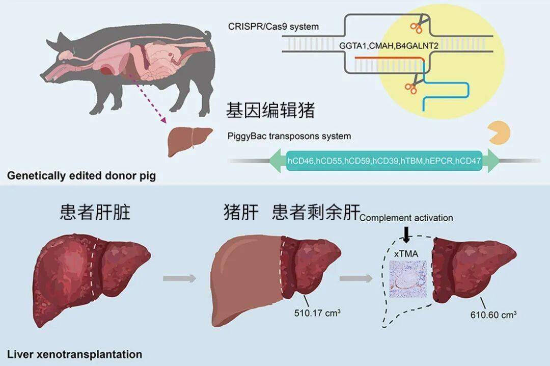 全球首例！中国团队成功将猪肝移植给活人