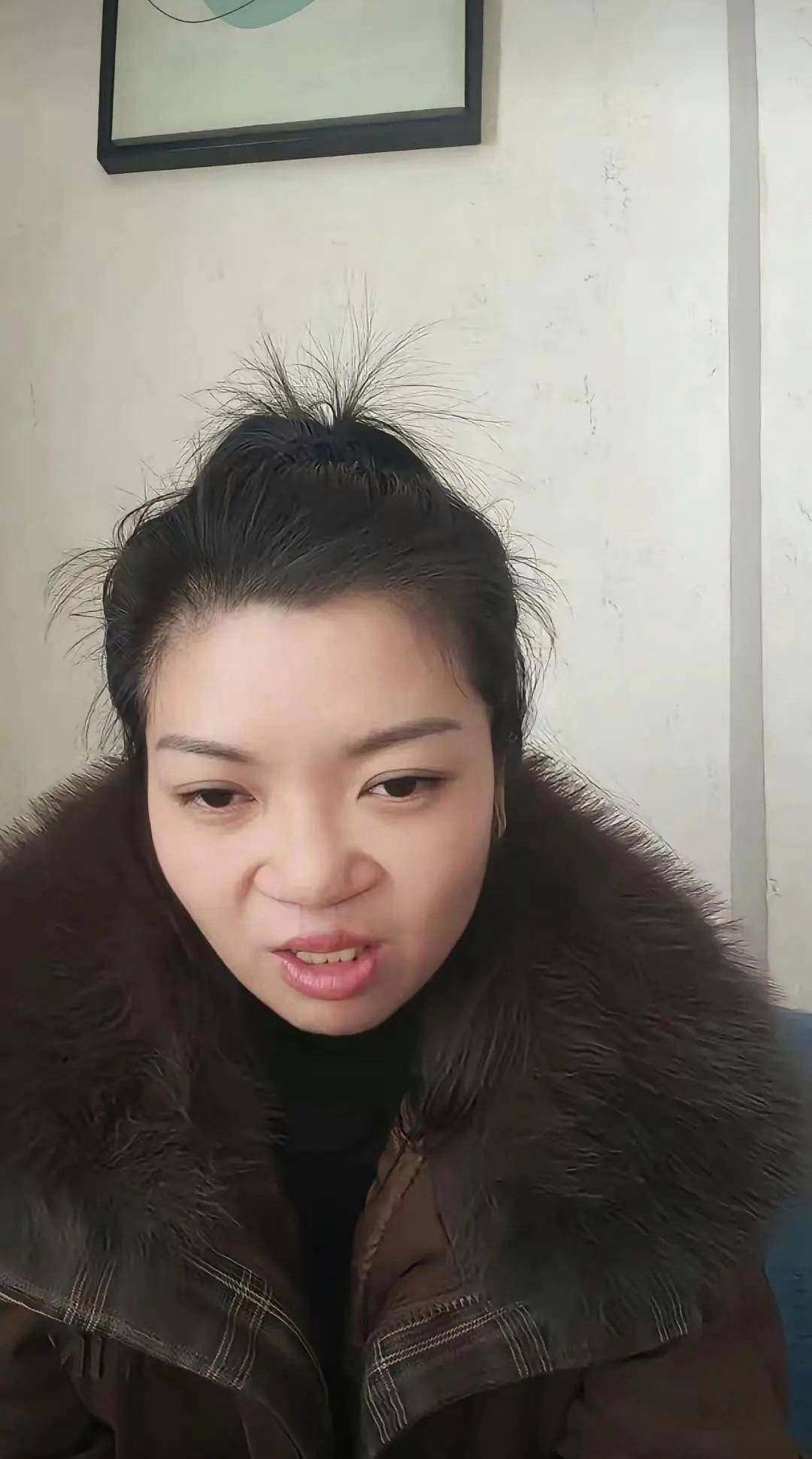 震惊！为声援李亚鹏，一漂亮女孩坦然展示自己唇腭裂手术前后照片