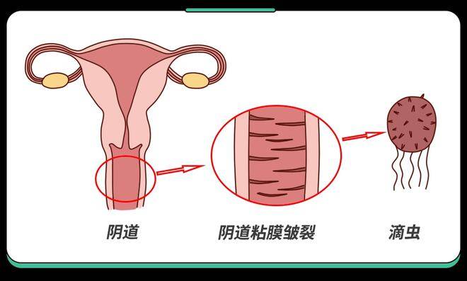 宫颈黏液脓性分泌物图片