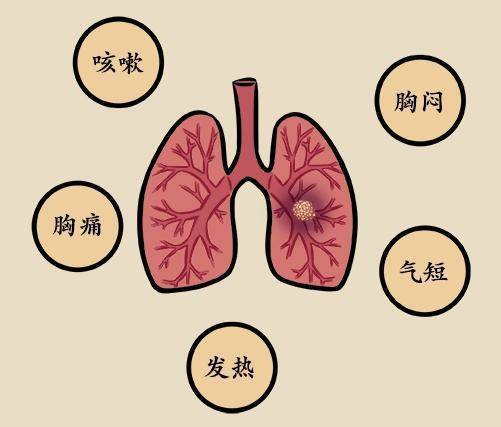 肺结节有什么症状图片