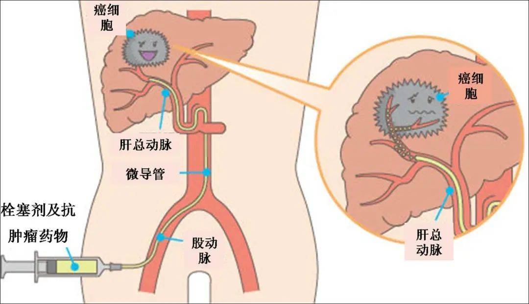 腹股沟动脉穿刺部位图片