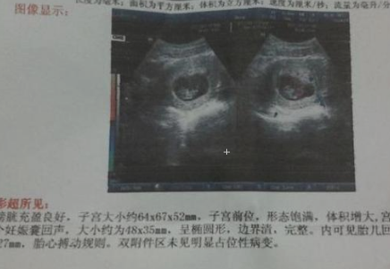 孕早期b超单初期图片