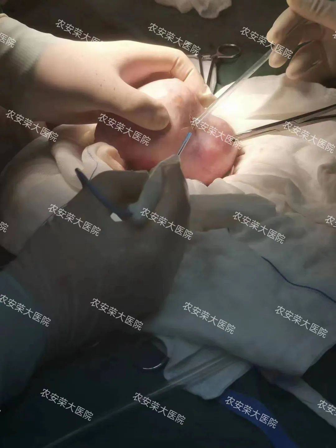 荣大医院妇科11cm巨型畸胎瘤被完整取出_肿物_周女士_卵巢