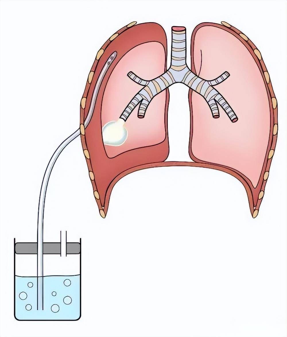 最常采取的治疗方法是放置胸腔闭式引流管,由水封瓶平衡大气压和胸腔