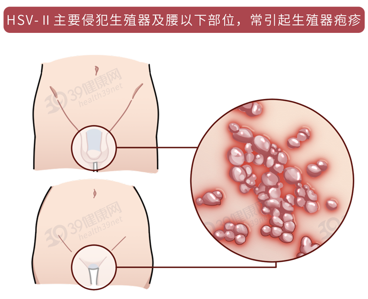 怎么在性生活前,判断对象有无性病？这3点或许有帮助