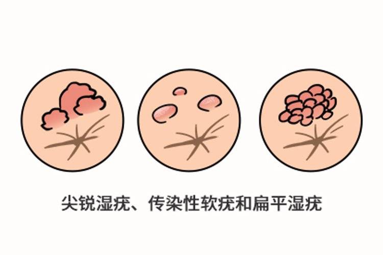 怎么在性生活前,判断对象有无性病？这3点或许有帮助