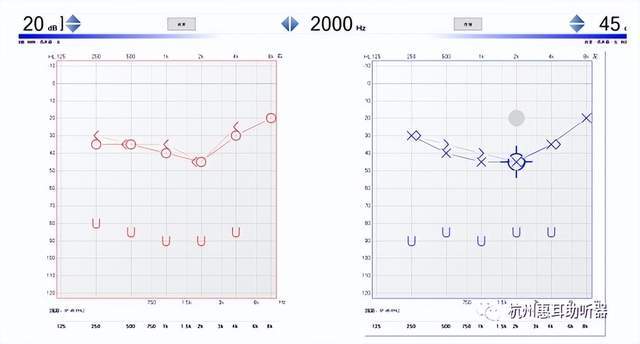 純音聽力:右耳37.2db,左耳41.