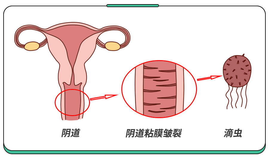 导致小儿阴道炎的原因有哪些？