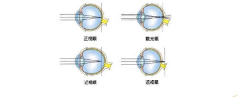 近视眼镜成像示意图图片