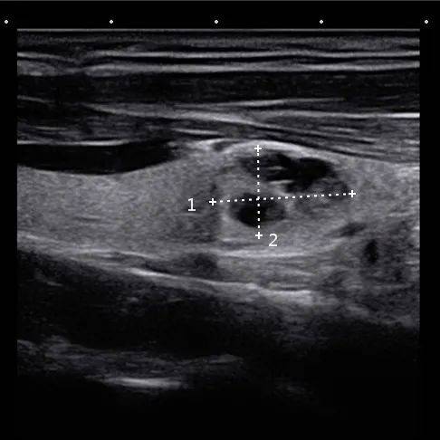 甲状腺结节超声图像解读?