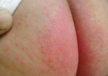 宝宝红屁屁了,最好别用爽身粉,这样护理才正确!_妈妈_孩子_患处