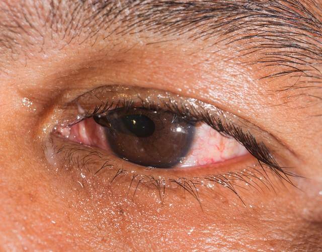 医生:眼睛出现这5种异常别大意!或是疾病的前兆,去医院查查