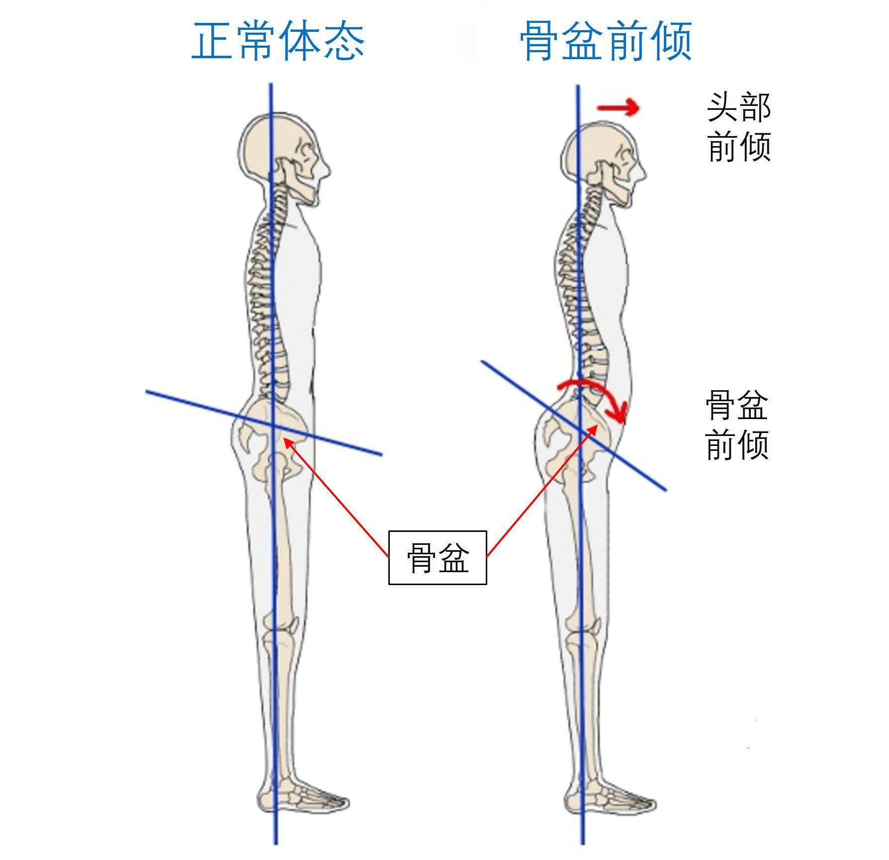 骨盆前倾能治好吗图片