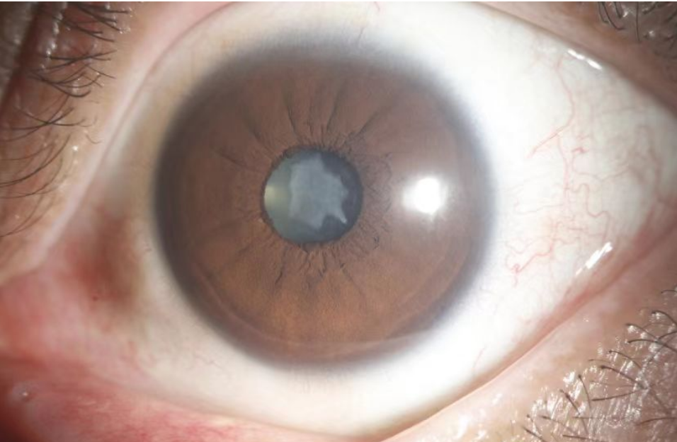 东莞光明眼科医院专家提醒:没曾想用筋膜枪放松眼球却敲出了白内障?