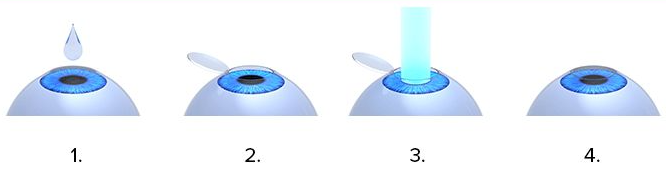 英文縮寫為fs-lasik,也 常常被大家稱為