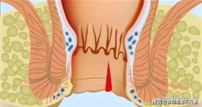 肛門_直腸_疾病