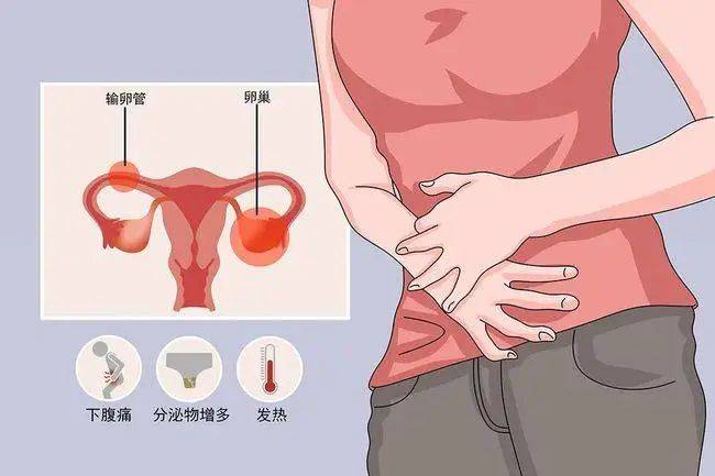 因此也常常把盆腔腹膜炎,宫旁结缔组织炎和卵巢,输卵管的炎症统称为