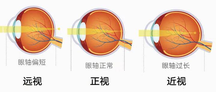 近視後,眼軸長度每增長1mm,大約對應200-250度近視.