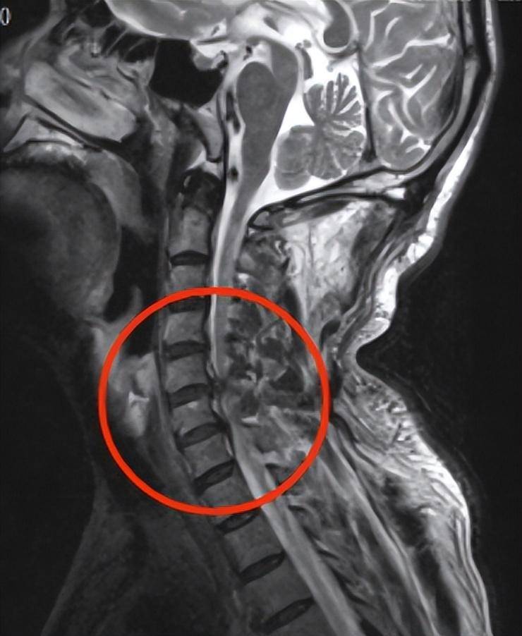 颈3/4～6/7椎间盘不同程度向后突出,硬膜囊受压,颈脊髓出现不均匀信号
