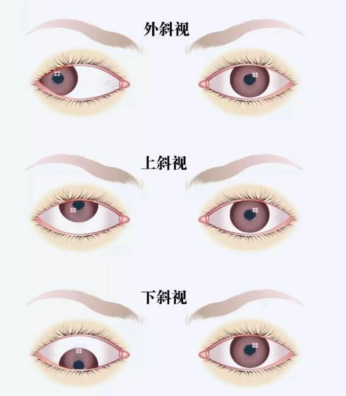 孩子斜视,应该怎么处理?听听王新院长怎么讲→_视觉_儿童_双眼