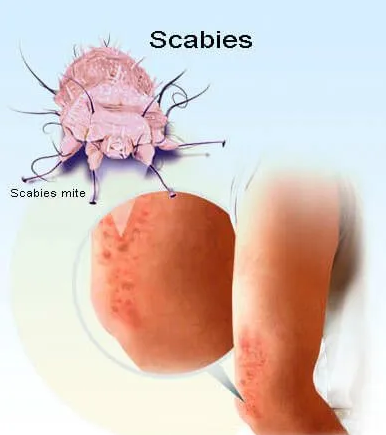 疥疮感染原因图片