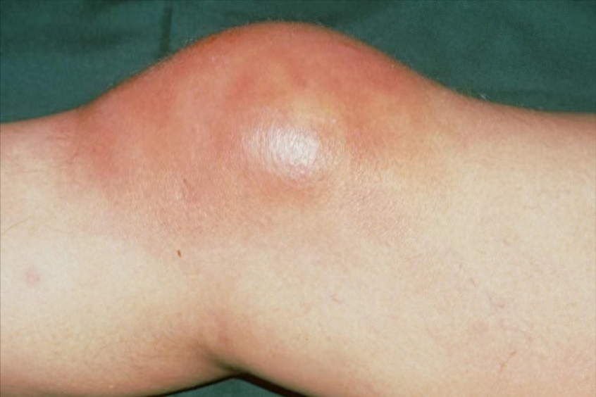 膝盖积液症状有哪些图片