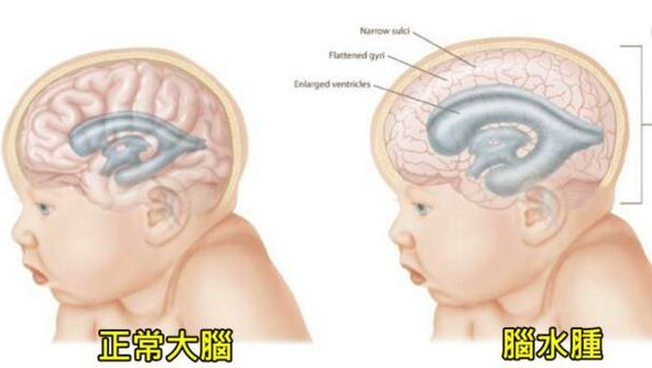 先天性的脑积水胎儿能生下来?脑积水相关知识科普_患者_疾病_情况