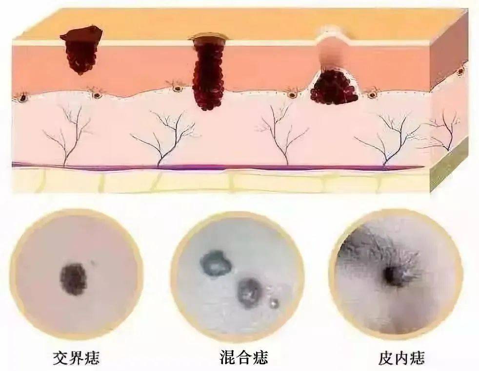 女性肛门旁边长痣图片