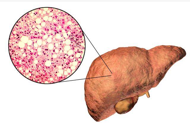 同时,缺乏足够的维生素,矿物质和抗氧化物质,也会影响肝脏的正常功能.