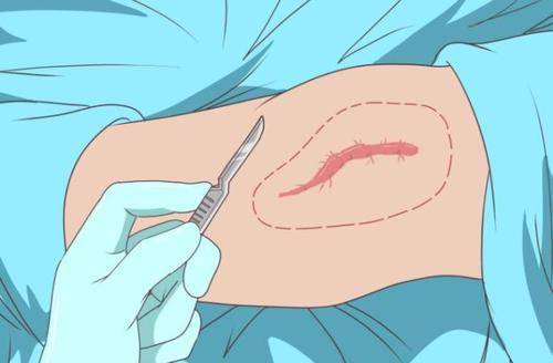 手术疤痕增生与凹陷的原因:沈阳肤康为你解析手术疤痕